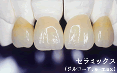 セラミックス