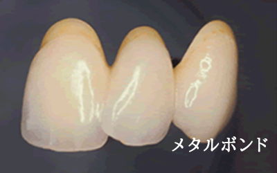 メタルボンド